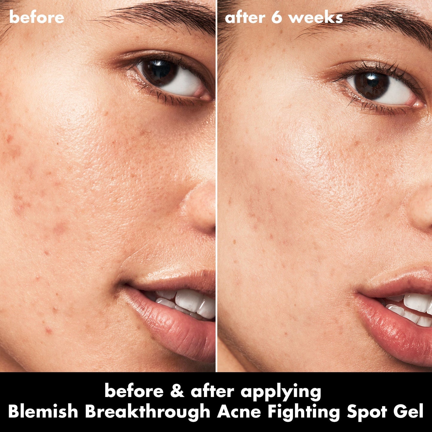 blemish-breakthrough-acne-fighting-spot-gel-c1 0326_EDU_BB_SpotGel_BA_ISABELLA.jpg