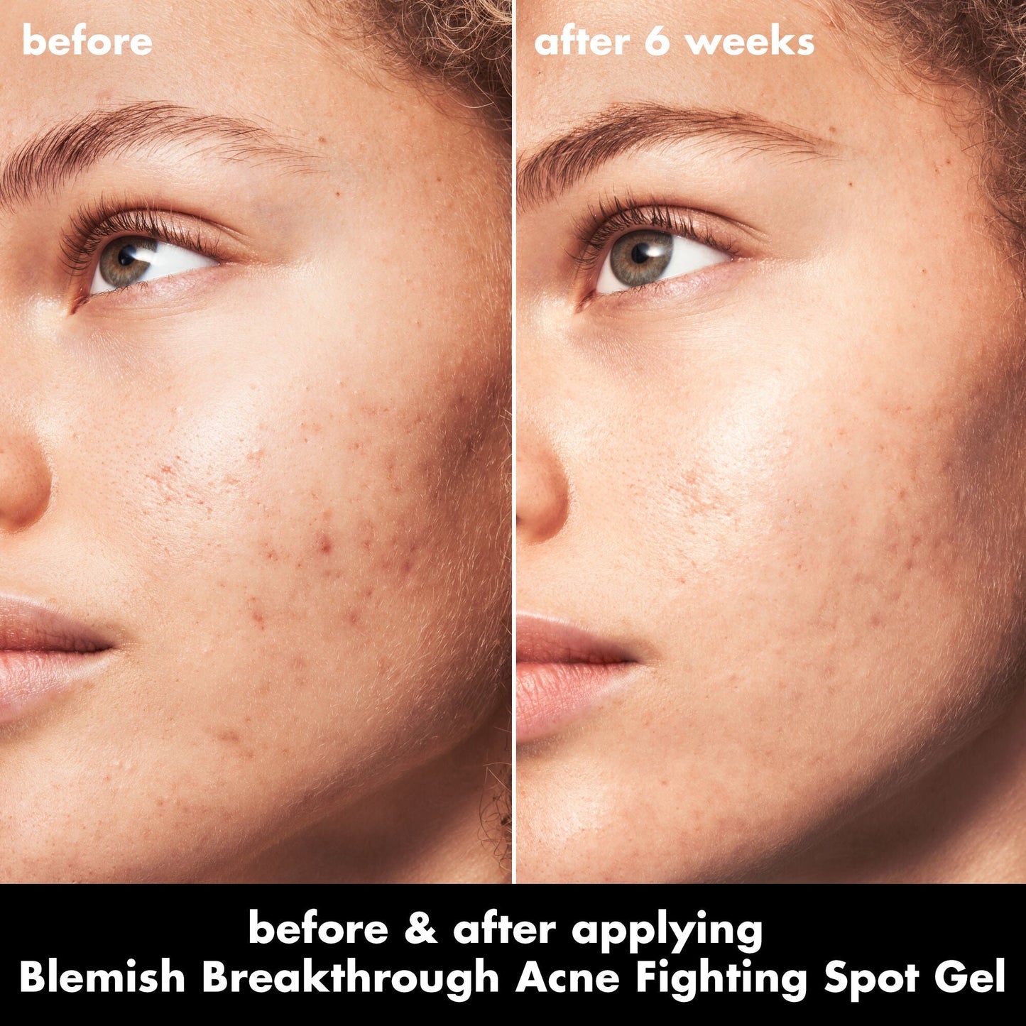 blemish-breakthrough-acne-fighting-spot-gel-c1 0326_EDU_BB_SpotGel_BA_MARLEY.jpg