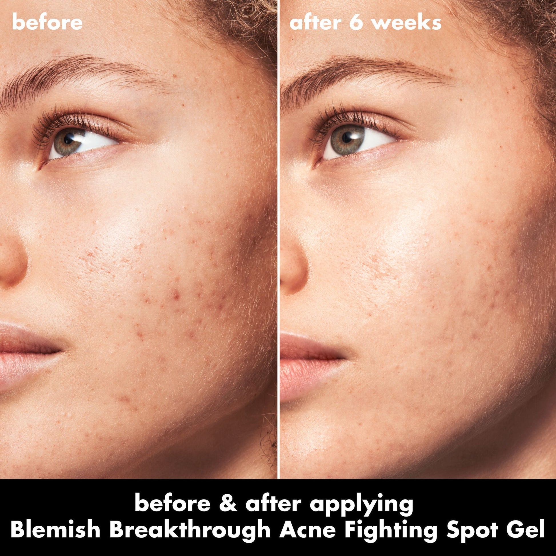 blemish-breakthrough-acne-fighting-spot-gel-c1 0326_EDU_BB_SpotGel_BA_MARLEY.jpg