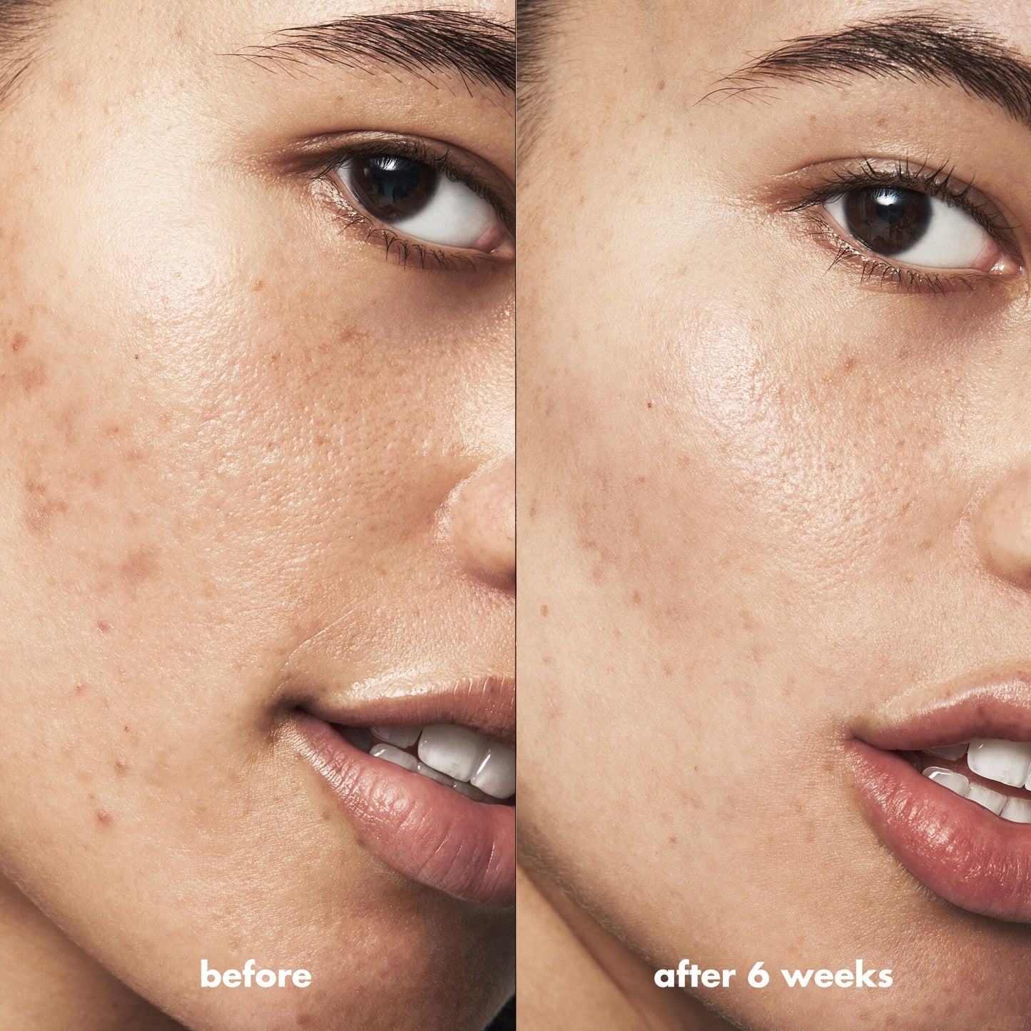 blemish-breakthrough-acne-calming-water-cream-o8 Acne_PDP_Isabella_Before_After_84ce713a-22d2-4bb9-aad7-445c7b27b1c9.jpg