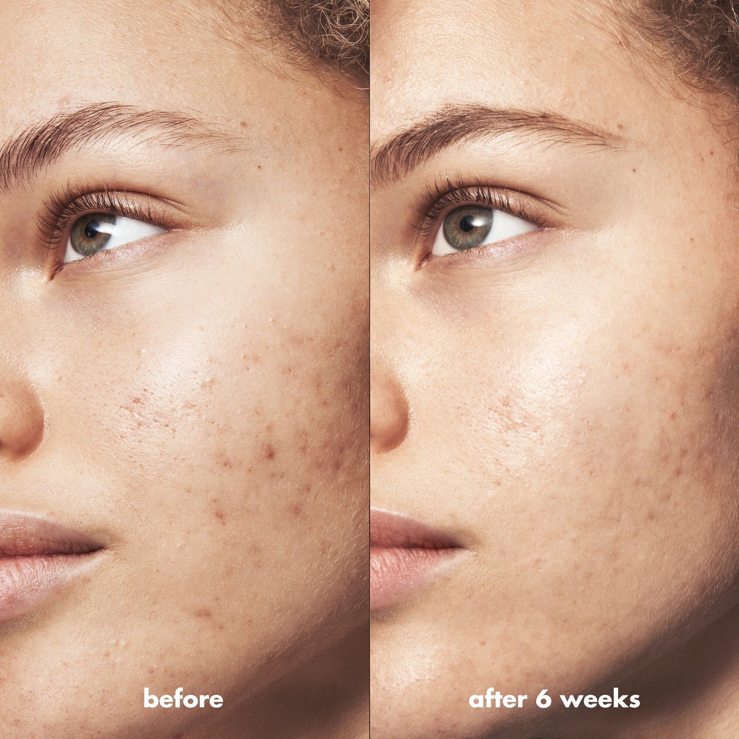 blemish-breakthrough-acne-calming-water-cream-mini-m1 Acne_PDP_Marley_Before_After_acf01478-a58b-47ce-99b5-2ef1dc022f9b.jpg